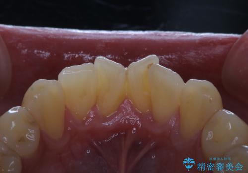 PMTCで笑った時の口元を自然に明るくしたいの治療前