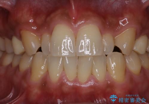 PMTCで笑った時の口元を自然に明るくしたいの治療後