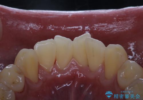 PMTCで笑った時の口元を自然に明るくしたいの治療後