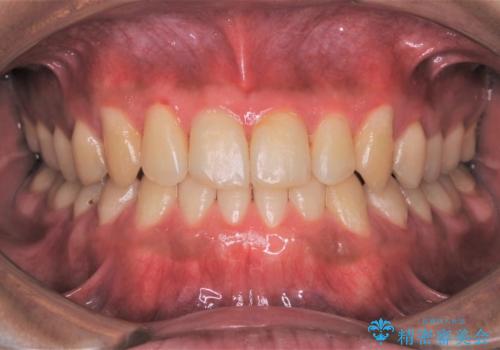 矯正治療を終えてのクリーニングの症例 治療後
