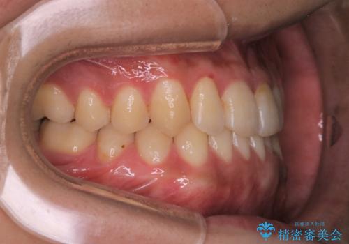矯正治療を終えてのクリーニングの治療後