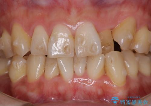 インビザラインでのマウスピース矯正中に歯を白くしたいの治療前