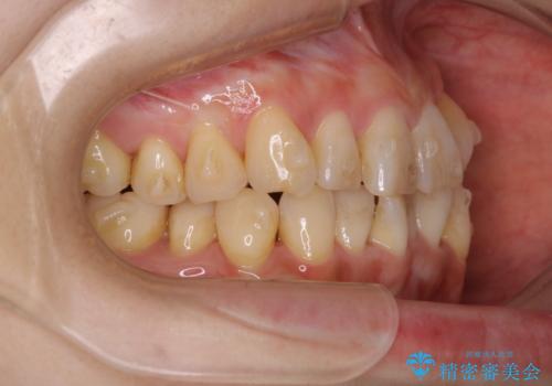 インビザラインでのマウスピース矯正中に歯を白くしたいの治療前