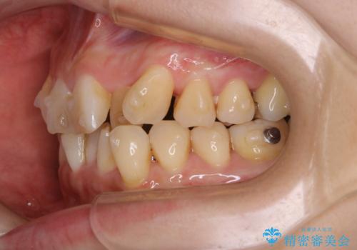 インビザラインでのマウスピース矯正中に歯を白くしたいの治療前
