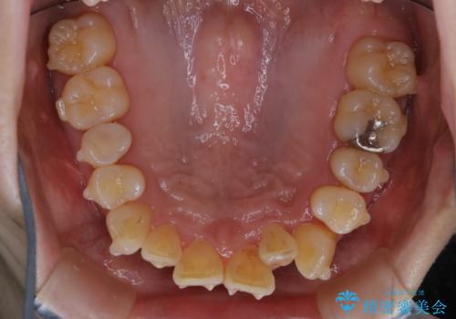 インビザラインでのマウスピース矯正中に歯を白くしたいの治療前