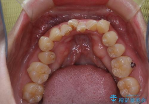 インビザラインでのマウスピース矯正中に歯を白くしたいの治療前