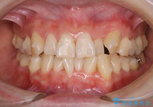 インビザラインでのマウスピース矯正中に歯を白くしたいの治療後