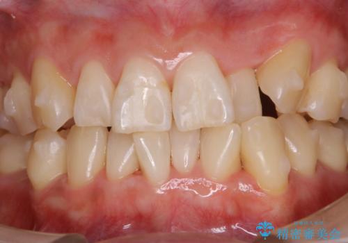 インビザラインでのマウスピース矯正中に歯を白くしたいの治療後