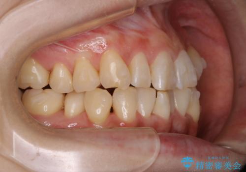 インビザラインでのマウスピース矯正中に歯を白くしたいの治療後