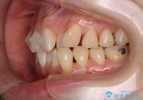 インビザラインでのマウスピース矯正中に歯を白くしたいの治療後
