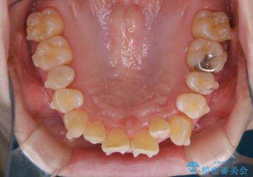 インビザラインでのマウスピース矯正中に歯を白くしたいの治療後