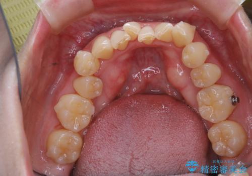 インビザラインでのマウスピース矯正中に歯を白くしたいの治療後