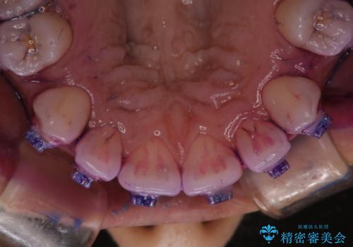 20代女性 ワイヤー矯正中にワイヤーを外してきれいにクリーニンングの治療前