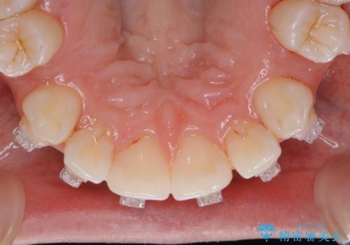 20代女性 ワイヤー矯正中にワイヤーを外してきれいにクリーニンングの治療後