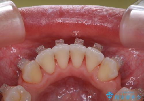 20代女性 ワイヤー矯正中にワイヤーを外してきれいにクリーニンングの治療後