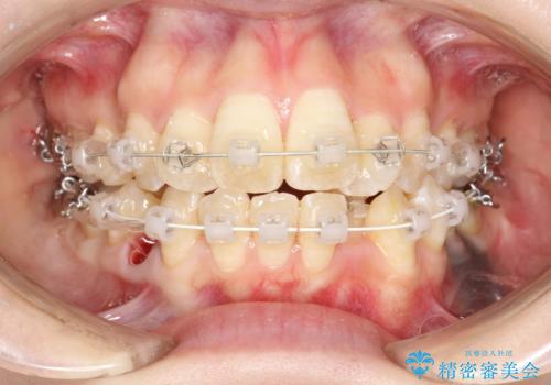 重度のガタガタ ワイヤーによる抜歯矯正の治療中