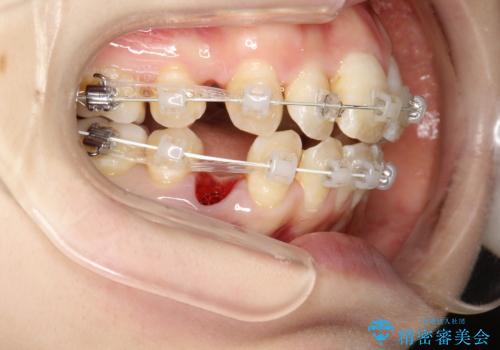 重度のガタガタ ワイヤーによる抜歯矯正の治療中