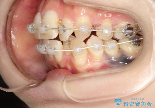 重度のガタガタ ワイヤーによる抜歯矯正の治療中