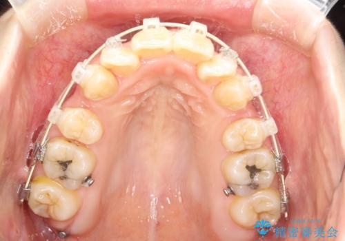 重度のガタガタ ワイヤーによる抜歯矯正の治療中