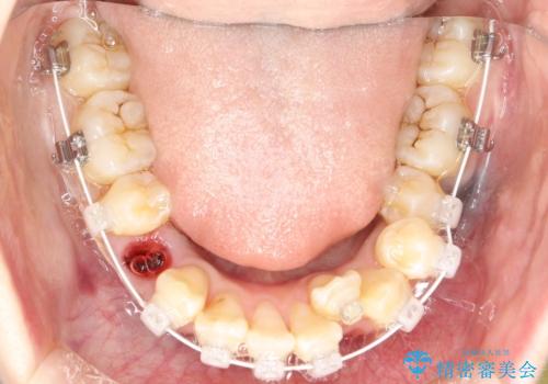 重度のガタガタ ワイヤーによる抜歯矯正の治療中