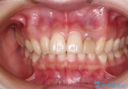 むし歯で変色した前歯をセラミッククラウンできれいにの治療前