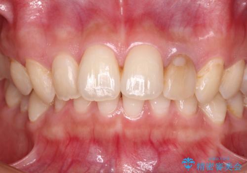 むし歯で変色した前歯をセラミッククラウンできれいにの治療前
