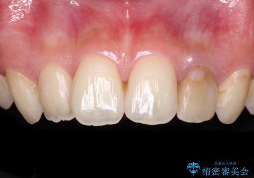 むし歯で変色した前歯をセラミッククラウンできれいにの症例 治療前