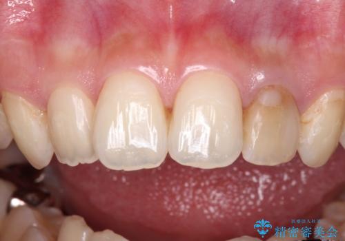 むし歯で変色した前歯をセラミッククラウンできれいにの治療前