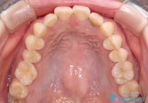 むし歯で変色した前歯をセラミッククラウンできれいにの治療前