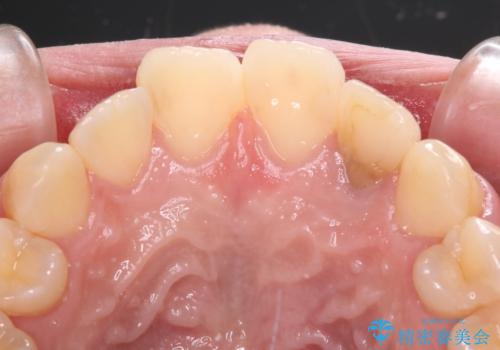 むし歯で変色した前歯をセラミッククラウンできれいにの治療前