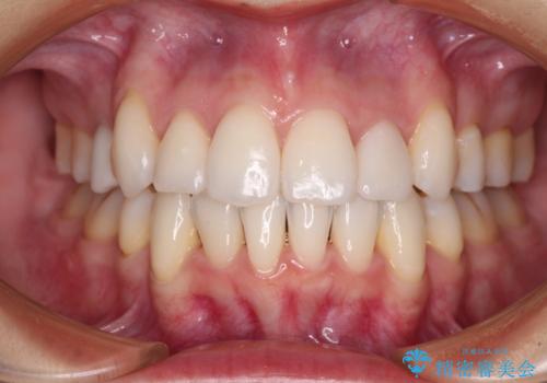 結婚式までに前歯をきれいにしたい 抜歯矯正とオールセラミッククラウンの症例 治療後