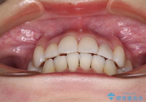 結婚式までに前歯をきれいにしたい 抜歯矯正とオールセラミッククラウンの治療後