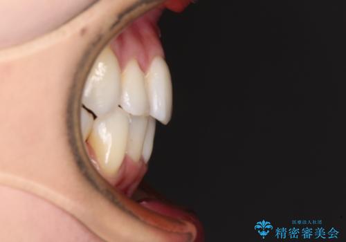 結婚式までに前歯をきれいにしたい 抜歯矯正とオールセラミッククラウンの治療後