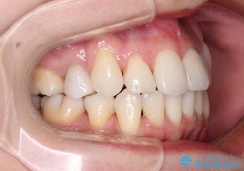 結婚式までに前歯をきれいにしたい 抜歯矯正とオールセラミッククラウンの治療後