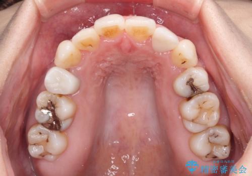 結婚式までに前歯をきれいにしたい 抜歯矯正とオールセラミッククラウンの治療後