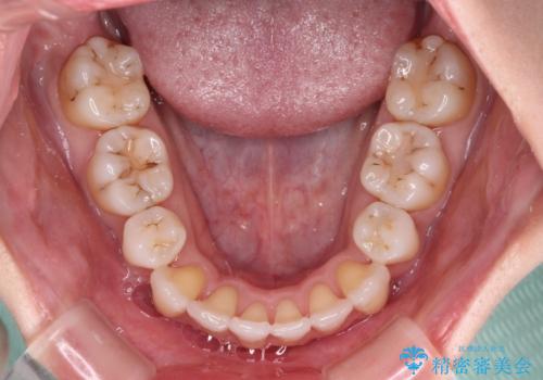 結婚式までに前歯をきれいにしたい　抜歯矯正とオールセラミッククラウンの治療後