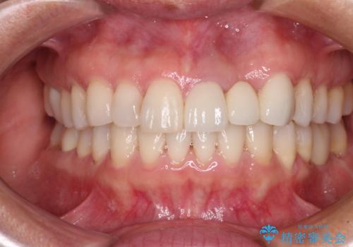 口元の突出感を治したい　治療中の歯も治したいの症例 治療後