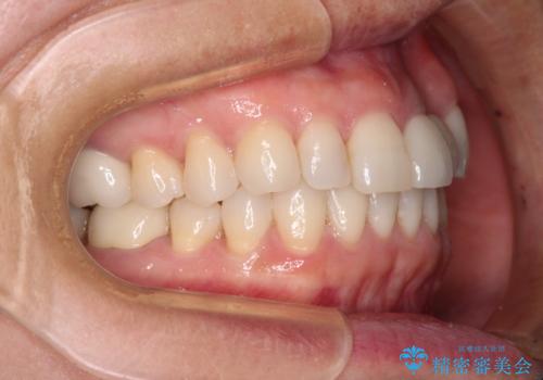 口元の突出感を治したい　治療中の歯も治したいの治療後