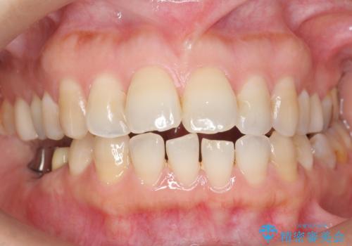 奥歯が割れている 抜歯してインプラントへ 40代女性の治療後