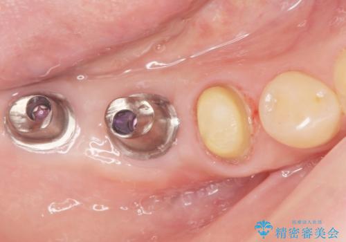 奥歯が割れている 抜歯してインプラントへ 40代女性の治療後