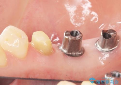 奥歯が割れている 抜歯してインプラントへ 40代女性の治療後