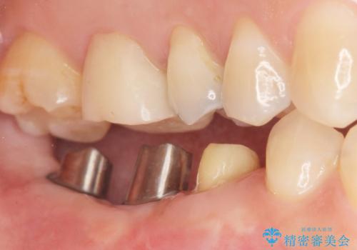 奥歯が割れている 抜歯してインプラントへ 40代女性の治療後