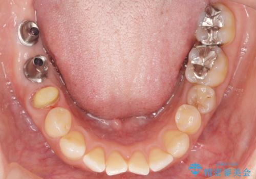 奥歯が割れている 抜歯してインプラントへ 40代女性の治療後