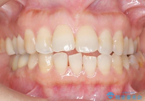 奥歯が割れている 抜歯してインプラントへ 40代女性の治療後