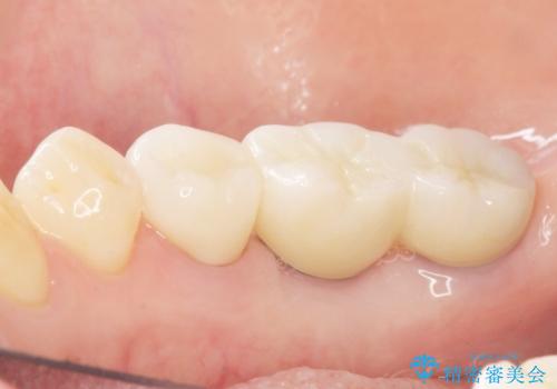 奥歯が割れている 抜歯してインプラントへ 40代女性の治療後