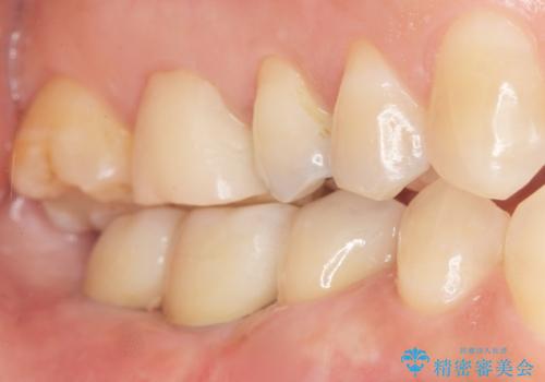 奥歯が割れている 抜歯してインプラントへ 40代女性の治療後