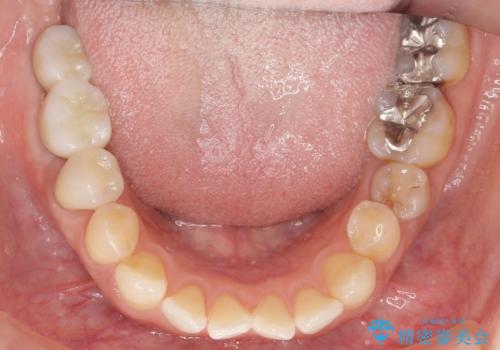 奥歯が割れている 抜歯してインプラントへ 40代女性の治療後