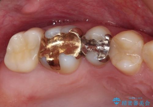 奥歯のむし歯が痛む セラミッククラウンとゴールドインレーによるむし歯治療の治療後