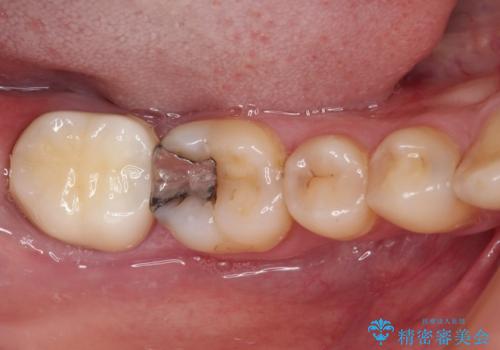 奥歯のむし歯が痛む　セラミッククラウンとゴールドインレーによるむし歯治療の治療後