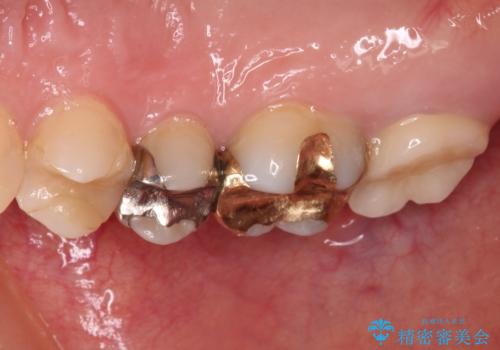 奥歯のむし歯が痛む セラミッククラウンとゴールドインレーによるむし歯治療の治療後